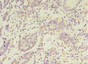 PSKH2 Antibody - Immunohistochemistry of paraffin-embedded human gastric cancer at dilution 1:100