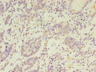 PSKH2 Antibody - Immunohistochemistry of paraffin-embedded human gastric cancer using PSKH2 Antibody at dilution of 1:100