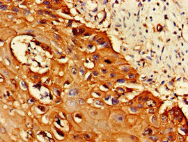 PSMA1 Antibody - Immunohistochemistry of paraffin-embedded human cervical cancer at dilution of 1:100