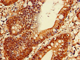 PSMA1 Antibody - Immunohistochemistry of paraffin-embedded human colon cancer at dilution of 1:100