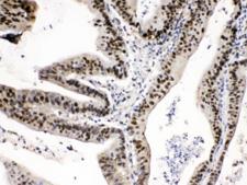 PSMA1 Antibody - IHC testing of FFPE human intestine cancer tissue with PSAT1 antibody at 1ug/ml. HIER: steam section in pH6 citrate buffer for 20 min.