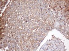 PSMA2 Antibody - IHC of paraffin-embedded Carcinoma of Human lung tissue using anti-PSMA2 mouse monoclonal antibody.