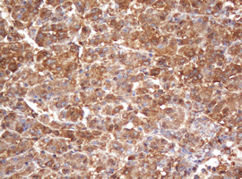 PSMA2 Antibody - IHC of paraffin-embedded Carcinoma of Human liver tissue using anti-PSMA2 mouse monoclonal antibody(Purified PSMA2 (Proteasome 20S alpha 2) mouse monoclonal antibody, Clone 3D9.