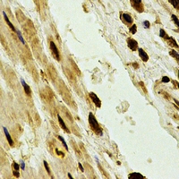 PSMA2 Antibody - Immunohistochemical analysis of PSMA2 staining in human esophageal cancer formalin fixed paraffin embedded tissue section. The section was pre-treated using heat mediated antigen retrieval with sodium citrate buffer (pH 6.0). The section was then incubated with the antibody at room temperature and detected using an HRP conjugated compact polymer system. DAB was used as the chromogen. The section was then counterstained with hematoxylin and mounted with DPX.