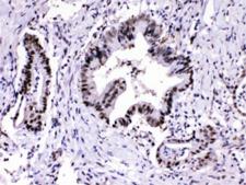 PSMA3 Antibody - IHC testing of FFPE human intestine cancer tissue with PSMA3 antibody at 1ug/ml. HIER: steam section in pH6 citrate buffer for 20 min.