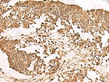 PSMA3 Antibody - Immunohistochemistry of paraffin-embedded Human lung cancer tissue  using PSMA3 Polyclonal Antibody at dilution of 1:50(×200)