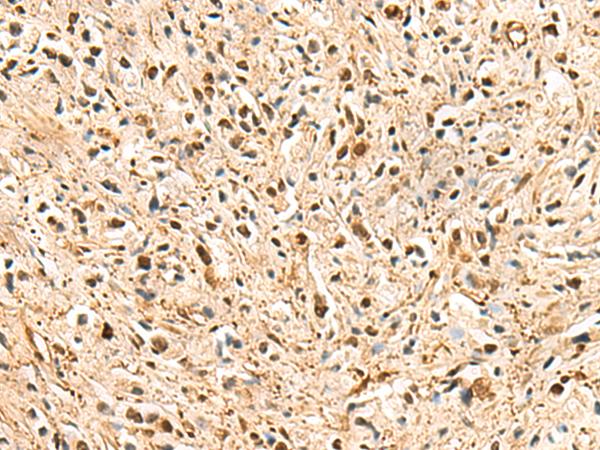 PSMA3 Antibody - Immunohistochemistry of paraffin-embedded Human prost ate cancer tissue  using PSMA3 Polyclonal Antibody at dilution of 1:50(×200)