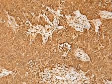 PSMA3 Antibody - Immunohistochemistry of paraffin-embedded Human ovarian cancer tissue  using PSMA3 Polyclonal Antibody at dilution of 1:30(×200)