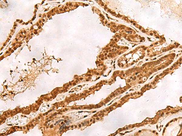 PSMA3 Antibody - Immunohistochemistry of paraffin-embedded Human thyroid cancer tissue  using PSMA3 Polyclonal Antibody at dilution of 1:30(×200)