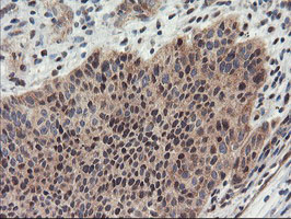 PSMA4 Antibody - IHC of paraffin-embedded Carcinoma of Human bladder tissue using anti-PSMA4 mouse monoclonal antibody.
