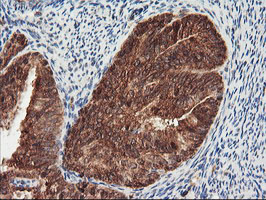 PSMA4 Antibody - IHC of paraffin-embedded Adenocarcinoma of Human endometrium tissue using anti-PSMA4 mouse monoclonal antibody.