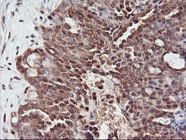 PSMA4 Antibody - IHC of paraffin-embedded Adenocarcinoma of Human ovary tissue using anti-PSMA4 mouse monoclonal antibody.