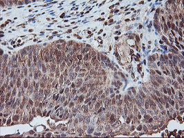 PSMA4 Antibody - IHC of paraffin-embedded Carcinoma of Human bladder tissue using anti-PSMA4 mouse monoclonal antibody.