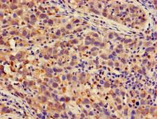 PSMA4 Antibody - Immunohistochemistry of paraffin-embedded human pancreatic cancer using PSMA4 Antibody at dilution of 1:100