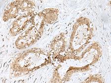 PSMA4 Antibody - Immunohistochemistry of paraffin-embedded Human breast cancer tissue  using PSMA4 Polyclonal Antibody at dilution of 1:45(×200)