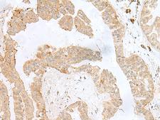 PSMA4 Antibody - Immunohistochemistry of paraffin-embedded Human liver cancer tissue  using PSMA4 Polyclonal Antibody at dilution of 1:50(×200)