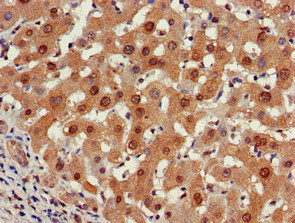 PSMA5 Antibody - Immunohistochemistry of paraffin-embedded human liver cancer at dilution of 1:100