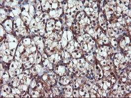 PSMA6 Antibody - IHC of paraffin-embedded Carcinoma of Human kidney tissue using anti-PSMA6 mouse monoclonal antibody.