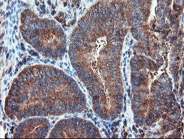PSMA6 Antibody - IHC of paraffin-embedded Adenocarcinoma of Human endometrium tissue using anti-PSMA6 mouse monoclonal antibody.