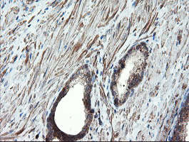 PSMA6 Antibody - IHC of paraffin-embedded Carcinoma of Human prostate tissue using anti-PSMA6 mouse monoclonal antibody.