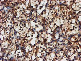 PSMA6 Antibody - IHC of paraffin-embedded Carcinoma of Human kidney tissue using anti-PSMA6 mouse monoclonal antibody.
