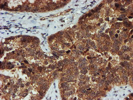 PSMA6 Antibody - IHC of paraffin-embedded Adenocarcinoma of Human ovary tissue using anti-PSMA6 mouse monoclonal antibody.