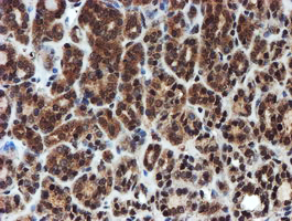 PSMA6 Antibody - IHC of paraffin-embedded Carcinoma of Human thyroid tissue using anti-PSMA6 mouse monoclonal antibody.