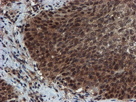 PSMA6 Antibody - IHC of paraffin-embedded Carcinoma of Human bladder tissue using anti-PSMA6 mouse monoclonal antibody.