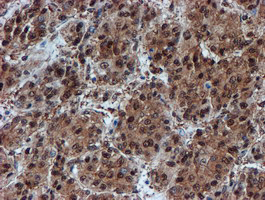 PSMA6 Antibody - IHC of paraffin-embedded Carcinoma of Human liver tissue using anti-PSMA6 mouse monoclonal antibody.