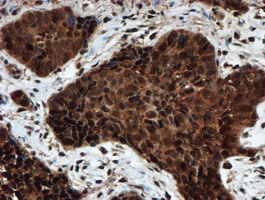 PSMA6 Antibody - IHC of paraffin-embedded Carcinoma of Human lung tissue using anti-PSMA6 mouse monoclonal antibody.