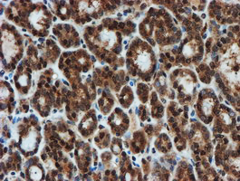 PSMA6 Antibody - IHC of paraffin-embedded Carcinoma of Human thyroid tissue using anti-PSMA6 mouse monoclonal antibody.