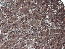PSMA6 Antibody - IHC of paraffin-embedded Carcinoma of Human liver tissue using anti-PSMA6 mouse monoclonal antibody.