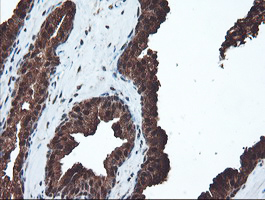 PSMA6 Antibody - IHC of paraffin-embedded Carcinoma of Human prostate tissue using anti-PSMA6 mouse monoclonal antibody.