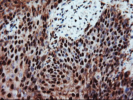 PSMA6 Antibody - IHC of paraffin-embedded Carcinoma of Human bladder tissue using anti-PSMA6 mouse monoclonal antibody.