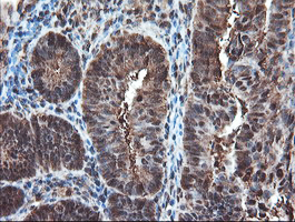 PSMA6 Antibody - IHC of paraffin-embedded Adenocarcinoma of Human endometrium tissue using anti-PSMA6 mouse monoclonal antibody.