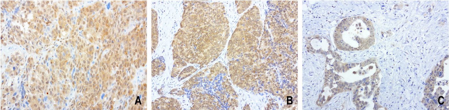 PSMA6 Antibody - Immunohistochemical staining of 3 cases of paraffin-embedded human endometrial carcinoma using anti-PSMA6 clone UMAB102 mouse monoclonal antibody  at 1:200 with Polink2 Broad HRP DAB detection kit; heat-induced epitope retrieval with GBI Citrate pH6.0 HIER buffer using pressure chamber for 3 minutes at 110C. Cytoplasmic, membraneous and nuclear staining is seen in all 3 case of tumor cells.