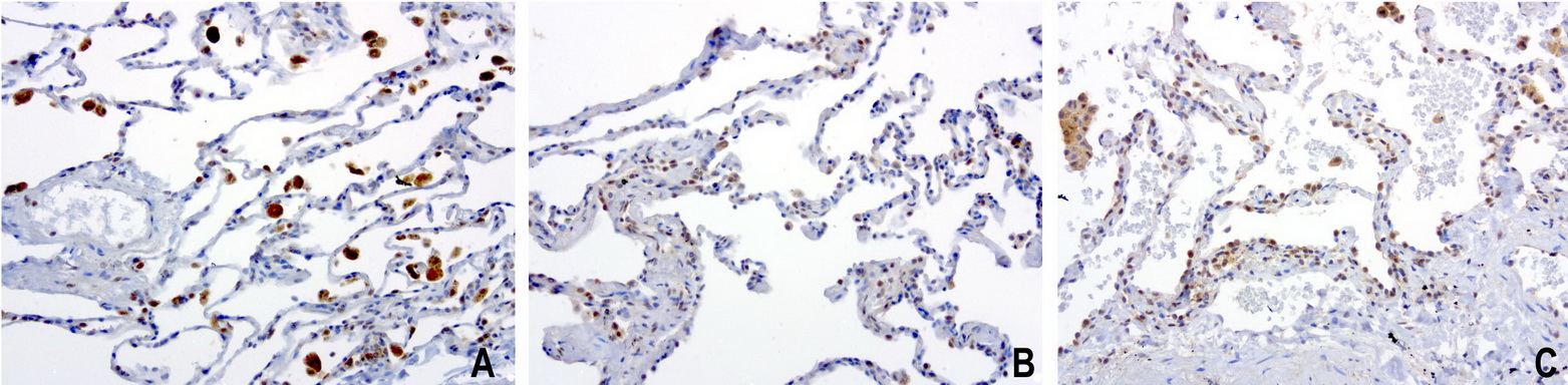 PSMA6 Antibody - Immunohistochemical staining of 3 cases of paraffin-embedded human lung using anti-PSMA6 clone UMAB102 mouse monoclonal antibody  at 1:200 with Polink2 Broad HRP DAB detection kit; heat-induced epitope retrieval with GBI Citrate pH6.0 HIER buffer using pressure chamber for 3 minutes at 110C. Most of the staining is nuclear in positive cells of the lung.