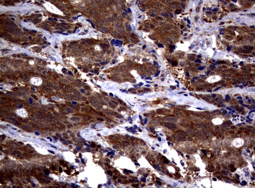 PSMA6 Antibody - Immunohistochemical staining of paraffin-embedded Adenocarcinoma of Human breast tissue using anti-PSMA6 mouse monoclonal antibody.  heat-induced epitope retrieval by 10mM citric buffer, pH6.0, 120C for 3min)