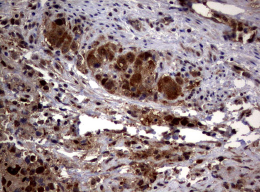 PSMA6 Antibody - Immunohistochemical staining of paraffin-embedded Adenocarcinoma of Human colon tissue using anti-PSMA6 mouse monoclonal antibody.  heat-induced epitope retrieval by 10mM citric buffer, pH6.0, 120C for 3min)