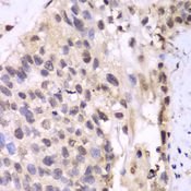 PSMA6 Antibody - Immunohistochemistry of paraffin-embedded human lung cancer using PSMA6 antibody at dilution of 1:100 (40x lens).