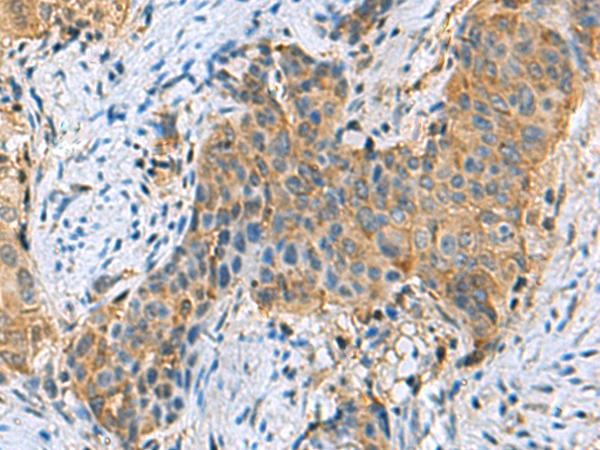 PSMA6 Antibody - Immunohistochemistry of paraffin-embedded Human cervical cancer tissue  using PSMA6 Polyclonal Antibody at dilution of 1:90(×200)