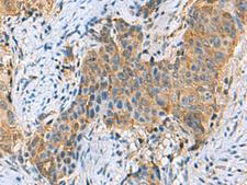 PSMA6 Antibody - Immunohistochemistry of paraffin-embedded Human cervical cancer tissue  using PSMA6 Polyclonal Antibody at dilution of 1:90(×200)