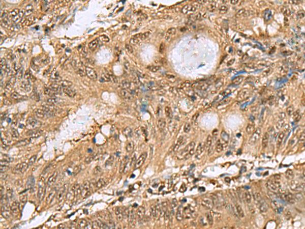 PSMA6 Antibody - Immunohistochemistry of paraffin-embedded Human colorectal cancer tissue  using PSMA6 Polyclonal Antibody at dilution of 1:65(×200)