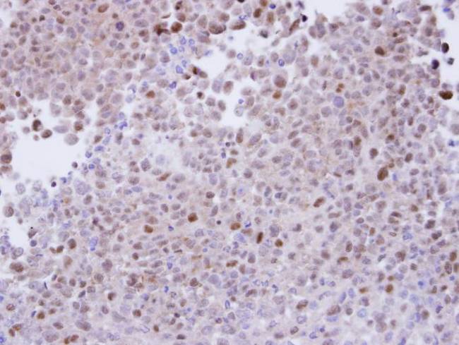 PSMA7 Antibody - IHC of paraffin-embedded CL1-5 xenograft using proteasome alpha 7 antibody at 1:100 dilution.
