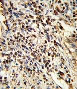 PSMA7 Antibody - Formalin-fixed and paraffin-embedded human lung carcinoma reacted with PSMA7 Antibody , which was peroxidase-conjugated to the secondary antibody, followed by DAB staining. This data demonstrates the use of this antibody for immunohistochemistry; clinical relevance has not been evaluated.