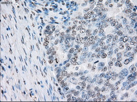 PSMA7 Antibody - Immunohistochemical staining of paraffin-embedded Adenocarcinoma of ovary tissue using anti-PSMA7 mouse monoclonal antibody. (Dilution 1:50).