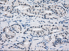 PSMA7 Antibody - Immunohistochemical staining of paraffin-embedded Carcinoma of prostate tissue using anti-PSMA7 mouse monoclonal antibody. (Dilution 1:50).