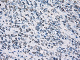 PSMA7 Antibody - Immunohistochemical staining of paraffin-embedded Carcinoma of bladder tissue using anti-PSMA7 mouse monoclonal antibody. (Dilution 1:50).