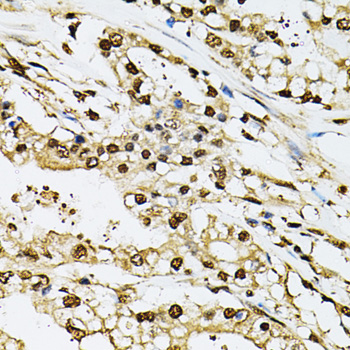 PSMB1 Antibody - Immunohistochemistry of paraffin-embedded human prostate cancer using PSMB1 antibodyat dilution of 1:100 (40x lens).