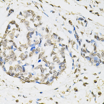 PSMB1 Antibody - Immunohistochemistry of paraffin-embedded human esophageal cancer using PSMB1 antibodyat dilution of 1:100 (40x lens).